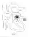 Fig. 14 - Methods for delivery of heart valve devices using intravascular ultrasound imaging