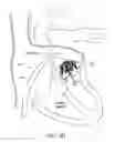 Fig. 15 - Methods for delivery of heart valve devices using intravascular ultrasound imaging