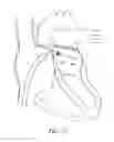 Fig. 17 - Methods for delivery of heart valve devices using intravascular ultrasound imaging