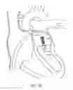 Fig. 18 - Methods for delivery of heart valve devices using intravascular ultrasound imaging