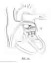 Fig. 19 - Methods for delivery of heart valve devices using intravascular ultrasound imaging