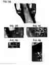 Fig. 07 - Modular device for preventing compression and instability in a segmental defect repair scaffold