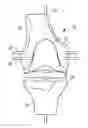 Fig. 01 - Tibial prosthesis for tibia with varus resection
