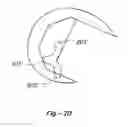 Fig. 04 - Multiple-cam, posterior-stabilized knee prosthesis