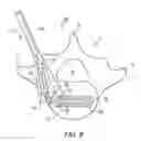 Fig. 05 - Expandable spinal implant and flexible driver