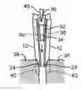 Fig. 01 - METHODS AND APPARATUS FOR INTERVERTEBRAL DISC PROSTHESIS INSERTION