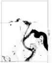 Fig. 03 - Treatment systems processes and devices addressing cerebral vasospasm/vasoconstriction