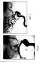 Fig. 05 - Treatment systems processes and devices addressing cerebral vasospasm/vasoconstriction
