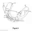 Fig. 05 - Cuspid and first bi-cuspid bite retainer for sleep apnea