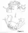 Fig. 08 - Cuspid and first bi-cuspid bite retainer for sleep apnea