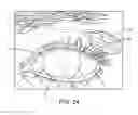 Fig. 15 - Combination treatment systems