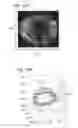 Fig. 25 - Optical surface identification for laser eye surgery