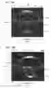 Fig. 26 - Optical surface identification for laser eye surgery