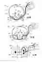 Fig. 06 - Device and method for simultaneous detection, monitoring and prevention of cerebral emboli