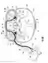Fig. 12 - Device and method for simultaneous detection, monitoring and prevention of cerebral emboli