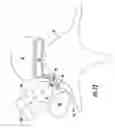 Fig. 17 - Device and method for simultaneous detection, monitoring and prevention of cerebral emboli