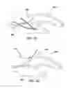 Fig. 13 - Systems and methods for creating arteriovenous (AV) fistulas
