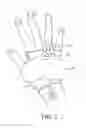 Fig. 04 - Catheter fixing band