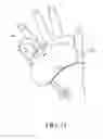 Fig. 13 - Catheter fixing band