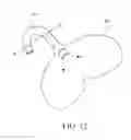 Fig. 14 - Catheter fixing band