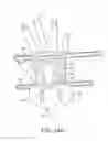 Fig. 17 - Catheter fixing band