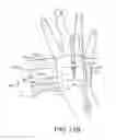 Fig. 22 - Catheter fixing band