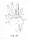 Fig. 24 - Catheter fixing band