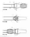 Fig. 08 - Systems and method for bypassing an anastomosis site
