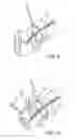 Fig. 10 - Systems and method for bypassing an anastomosis site