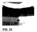 Fig. 20 - Systems and method for bypassing an anastomosis site
