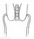 Fig. 01 - DEVICES AND METHODS FOR REDUCING THE RISK OF PRETERM LABOR AND PRETERM BIRTH