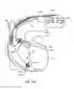 Fig. 75 - MLCC filter on an AIMD circuit board with conductive ground pin attached to a hermetic feedthrough ferrule