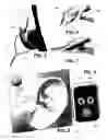 Fig. 05 - Transcutaneous electrostimulator and methods for electric stimulation