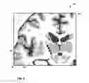 Fig. 07 - User interface with 3D environment for configuring stimulation therapy