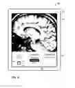 Fig. 35 - User interface with 3D environment for configuring stimulation therapy