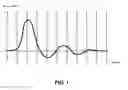 Fig. 02 - Methods and devices for tissue treatment using shock waves and electromagnetic field