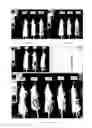 Fig. 04 - Compositions and methods for the detection or treatment of uterine leiomyosarcoma