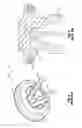 Fig. 03 - Pressure pumping valves and methods of making such valves