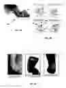 Fig. 05 - SYSTEMS AND METHODS FOR SERIAL TREATMENT OF A MUSCULAR-SKELETAL DEFORMITY