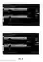 Fig. 09 - SYSTEMS AND METHODS FOR SERIAL TREATMENT OF A MUSCULAR-SKELETAL DEFORMITY