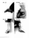Fig. 16 - SYSTEMS AND METHODS FOR SERIAL TREATMENT OF A MUSCULAR-SKELETAL DEFORMITY