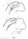 Fig. 02 - Hearing device comprising an electric cable