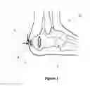 Fig. 02 - STRAIN-RELIEF ELEMENT FOR FOOTWEAR ARTICLES