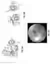 Fig. 18 - HAND-HELD PORTABLE FUNDUS CAMERA FOR SCREENING PHOTOGRAPHY