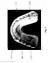 Fig. 08 - ORAL APPARATUS WITH RIGID SENSOR CAPTURE COMPONENT FOR STRONG COUPLING TO UPPER JAW