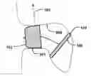 Fig. 01 - Left Atrial Appendage Occluder