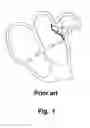 Fig. 02 - Left Atrial Appendage Occluder