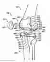Fig. 01 - DEVICES AND METHODS FOR KNEE REPLACEMENT
