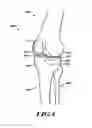 Fig. 04 - DEVICES AND METHODS FOR KNEE REPLACEMENT