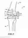 Fig. 05 - DEVICES AND METHODS FOR KNEE REPLACEMENT